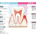 歯周病の初期症状の断面図｜健康な歯ぐきと3〜4mmの歯周ポケット比較