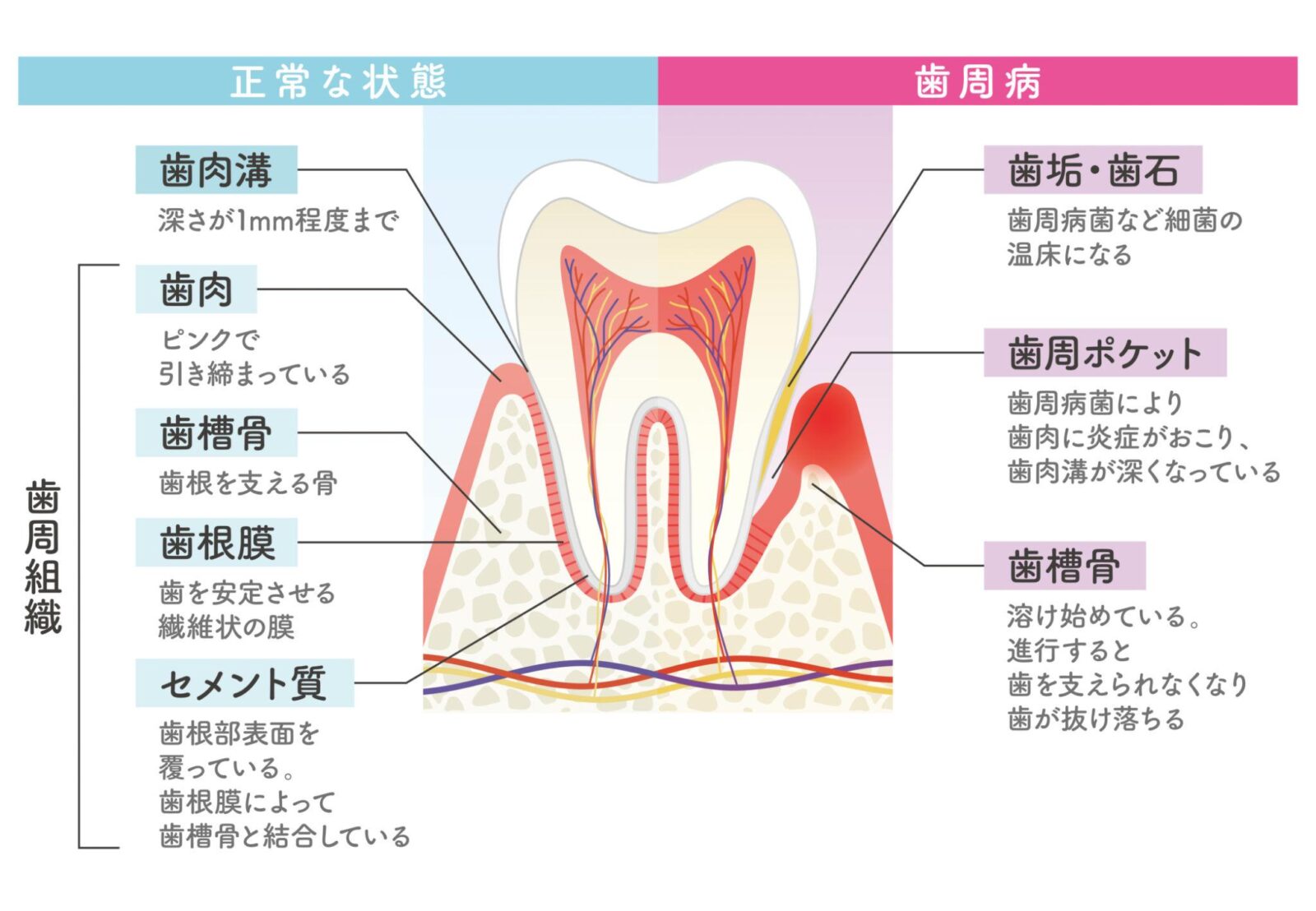 歯周病の初期症状の断面図｜健康な歯ぐきと3〜4mmの歯周ポケット比較