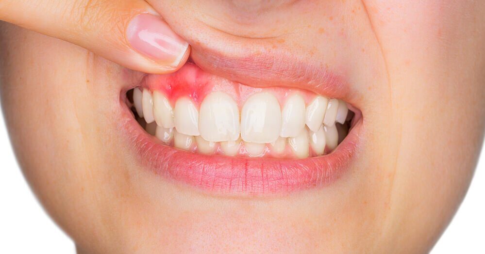 歯医者のクリーニングで血が出る理由